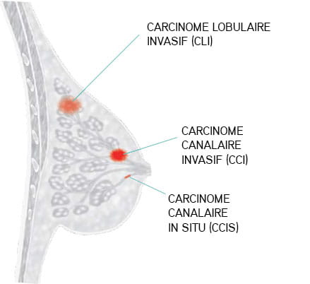 Breast Cancer Tumors